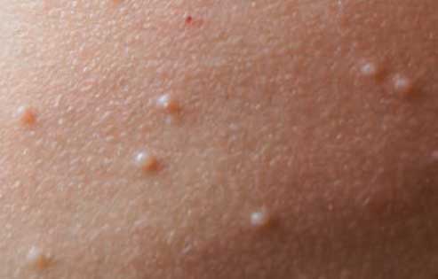 Molluscum-Contagiosum--Yeung Ho Hong 楊浩康