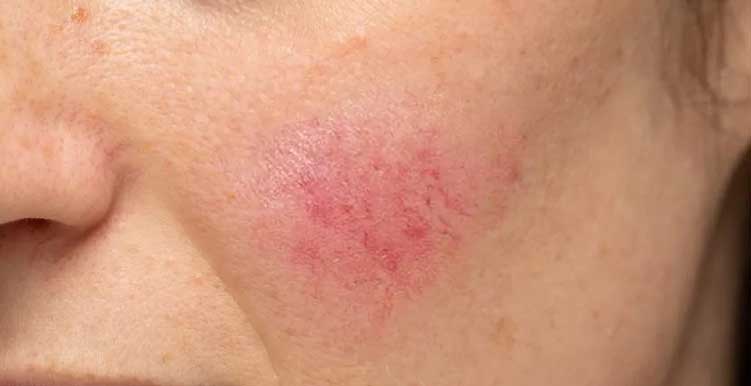 甚麼是玫瑰痤瘡 ?--Yeung Ho Hong 楊浩康