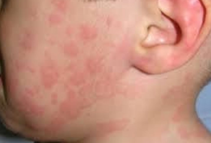 scarlet_fever,猩紅熱--Yeung Ho Hong 楊浩康