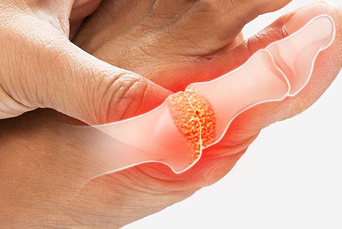 Living with Gout and How to Manage It - Yeung Ho Hong 楊浩康